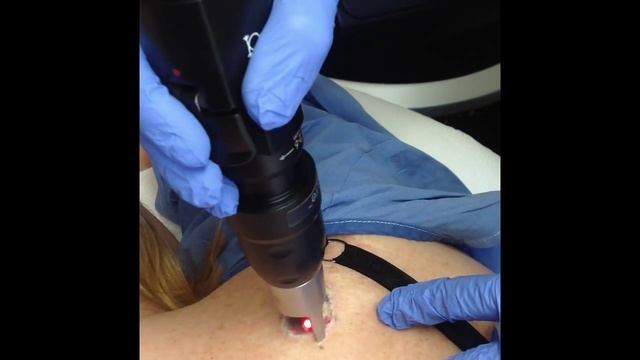 PicoSure Tattoo Removal смотреть онлайн