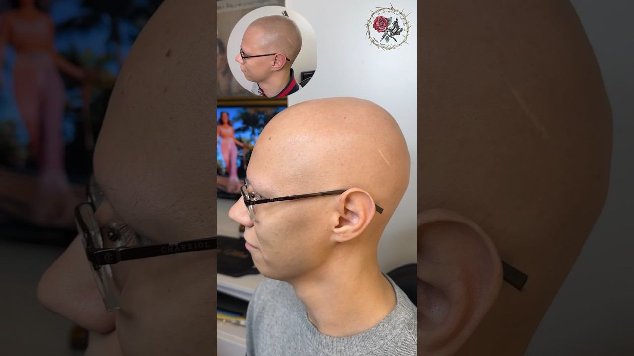 Тотальная алопеция скрыта трихопигментацией, тату волос. Scalp micropigmentation vs alopecia SMP