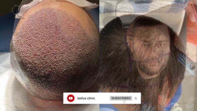 Hair transplant result after 6 months смотреть онлайн