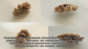 Как дробят камни в мочеточнике