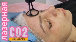 Лазерная шлифовка лица