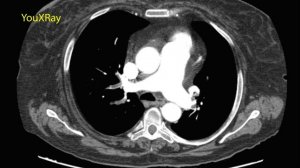 Лучевая диагностика ТЭЛА