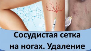 Сосудистая сетка на ногах