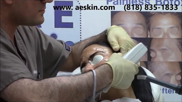 Forever Young BBL IPL Photofacial Demonstration 1 - A E Skin - Encino, CA - 818-835-1833 смотреть онлайн