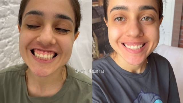 Коррекция десневой улыбки ? смотреть онлайн