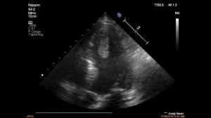 Флотирующий верхушечный тромб левого желудочка