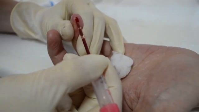 СОЭ по Панченкову – норма, как делают анализ смотреть онлайн