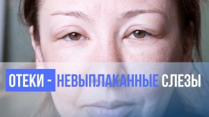 Отеки под глазами ПРИЧИНЫ. Психосоматика и причины отеков. Лимфодренажный транс