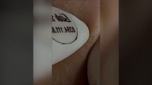 Popping huge blackheads and Pimple Popping Best Pimple Popping #2