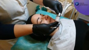 Протокол «Двойного пилинга с карбокситерапией» для комбинированной кожи лица