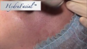 О процедуре ХАЙДРАФЭШЛ 1