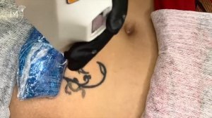 УДАЛЕНИЕ ТАТУИРОВКИ ЛАЗЕРОМ