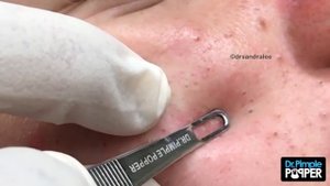 Blackhead Extractions in a Teenager with Acne