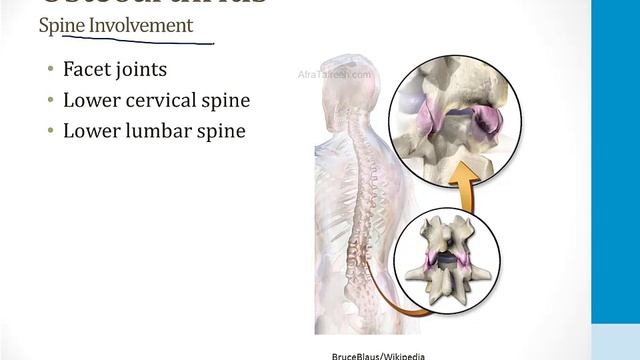 Опорно-двигательный аппарат USMLE - 3. Патология - 5.Остеоартрит