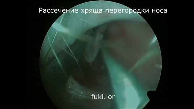 ЭНДОСКОПИЧЕСКАЯ СЕПТОПЛАСТИКА