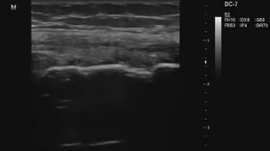 Повреждение внутренней боковой связки