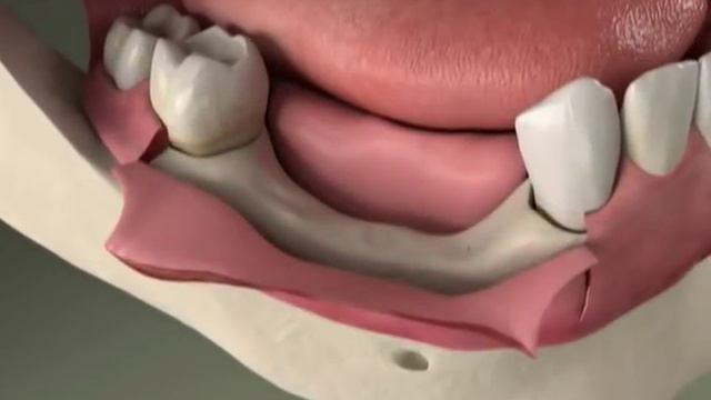 Dental Implants - Bone Grafting - Ridge Preservation in Denville, NJ смотреть онлайн