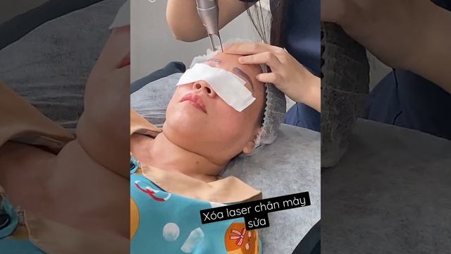 Xóa xăm laser chân mày sửa