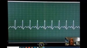 Monitor View of Sinus Rhythms