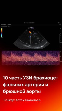 10 часть УЗИ брахиоцефальных артерий и брюшной аорты на Mindray Resona i9