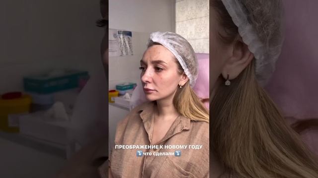 Омоложение лица с помощью комплексного метода Full Face: минус 5-10 лет за процедуру!