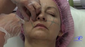 Укладываем канюлю в носослезную борозду