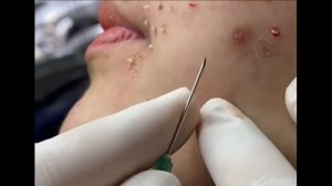 Удаление черных точек 2021 - Remoção de cravo 2021 - Pimple Popping 2021 -Blackhead Removal Ep01