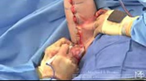 Plastic Surgery Arm Lift after weight loss - YouTube