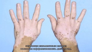 Пигментация кожи на руках причины