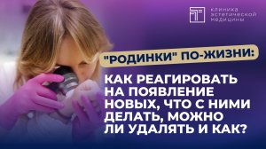 "Родинки" по-жизни: как реагировать на появление новых, что с ними делать, можно ли удалять и как?