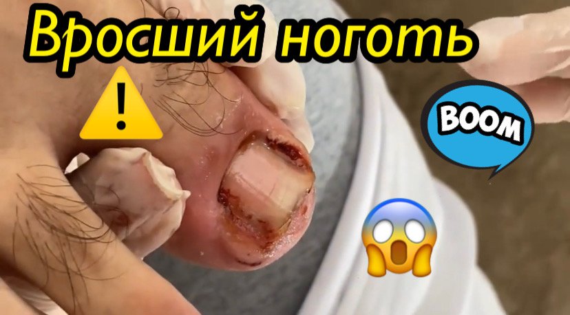 Вросший ноготь??⚠️??