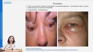 Трихинеллез