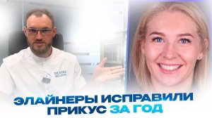 Элайнеры исправили прикус за год. Отбеливание зубов композитные реставрации. Стас Белоус Ульяновск