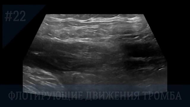 УЗИ сосудов. Спонтанные флотирующие движения тромба (пациент находится в покое).