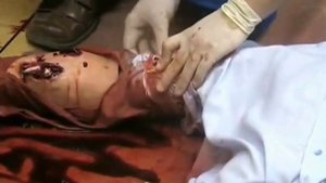 Методика наложения закрутки из подручных средств при кровотечении - meduniver.com