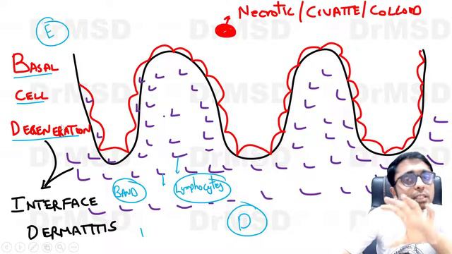 MAX JOSEPH spaces in Lichen Planus | Cytoid Bodies | Colloid | Civatte | Apoptotic | Saw Tooth rete