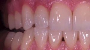 #Veneers Totalsanierung monolithisch