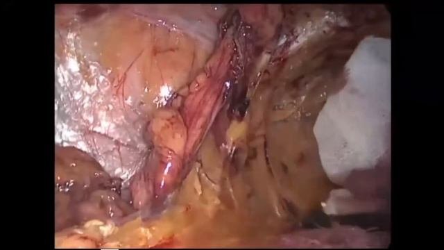Герниопластика TEP. Грыжа. Паховая грыжа.Total Extraperitoneal (TEP) Laparoscopic Inguinal Hernia