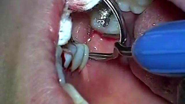 Профессиональная чистка пародонтальных карманов закрытым способом смотреть онлайн