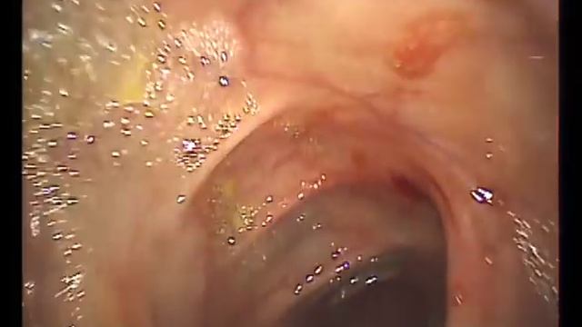 Полипы кишечника Колоноскопия в Мариуполе смотреть онлайн