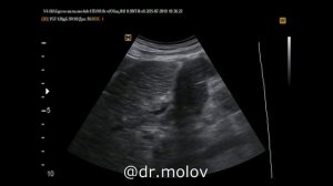 Тромбоз воротной вены+тромбоз НПВ на УЗИ(часть 3)