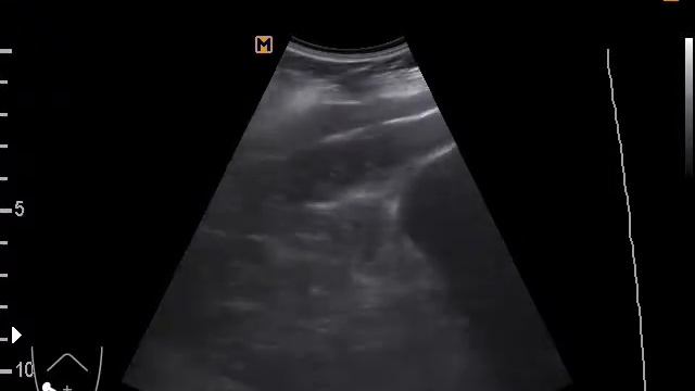 Очаговое образование брюшной полости (5-9-17) смотреть онлайн