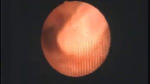 Полип цервикального канала на тонкой ножке. Удаление. Череповец.