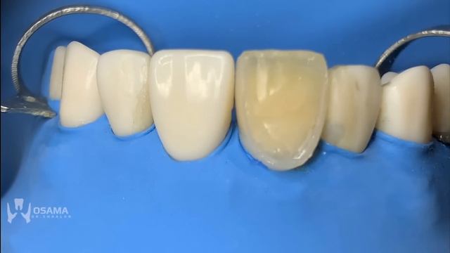 direct composite veneers with layering technique