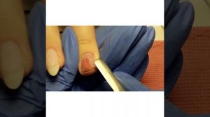 Наращивание акригелем, сломанный ноготь под корень.