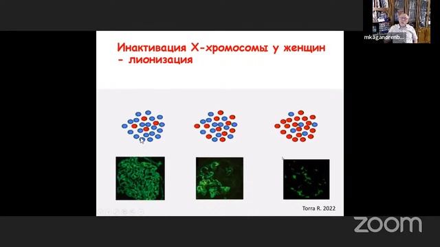 Синдром Альпорта у детей