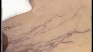 Микросклеротерапия сосудистых "звёздочек"