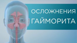 ОСЛОЖНЕНИЯ ГАЙМОРИТА