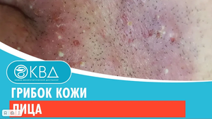 ? Грибок кожи лица. Клинический случай №380