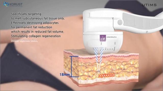 【東京形成美容外科】UTIMS A3 体への照射も可能 смотреть онлайн
